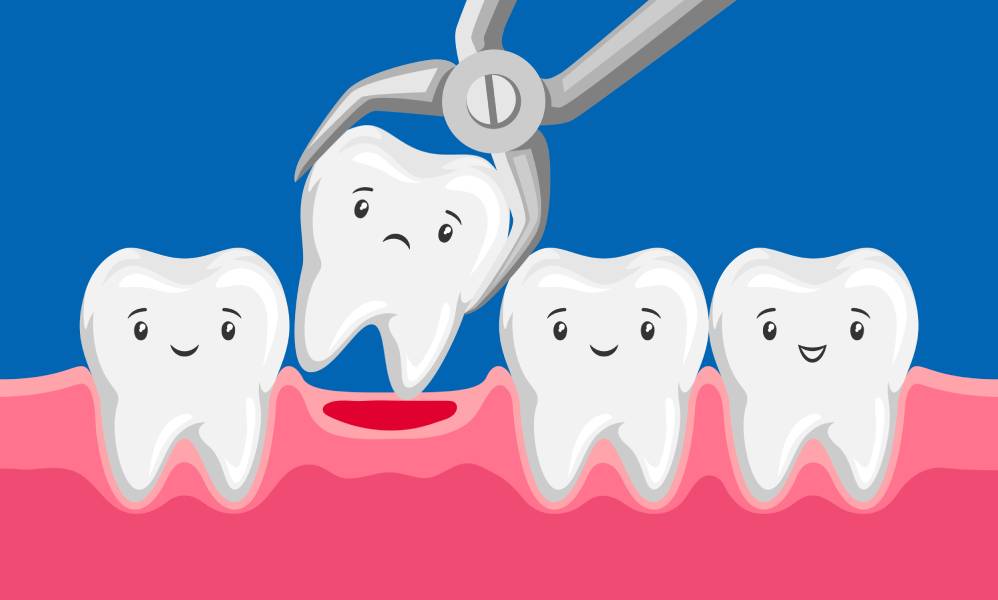 Why Choose Tooth Extractions